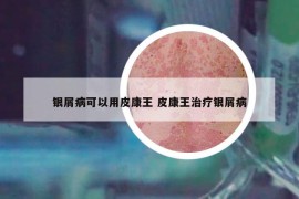 銀屑病可以用皮康王 皮康王治療銀屑病