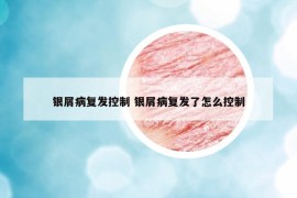 銀屑病復(fù)發(fā)控制 銀屑病復(fù)發(fā)了怎么控制