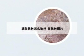 掌脂膿包怎么治療 掌膿包圖片