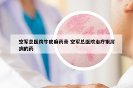 空軍總醫(yī)院牛皮癬藥膏 空軍總醫(yī)院治療銀屑病的藥