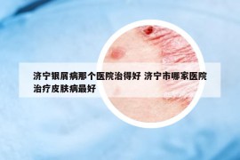 濟(jì)寧銀屑病那個醫(yī)院治得好 濟(jì)寧市哪家醫(yī)院治療皮膚病最好