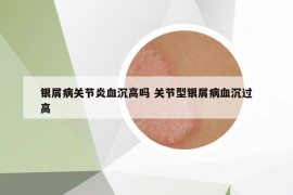 銀屑病關(guān)節(jié)炎血沉高嗎 關(guān)節(jié)型銀屑病血沉過(guò)高