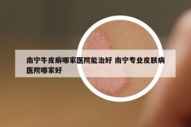 南寧牛皮癬哪家醫(yī)院能治好 南寧專業(yè)皮膚病醫(yī)院哪家好