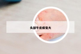 頭部牛皮癬變大