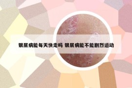 銀屑病能每天快走嗎 銀屑病能不能劇烈運動