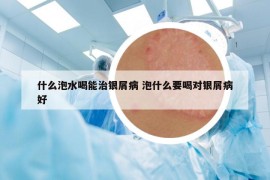 什么泡水喝能治銀屑病 泡什么要喝對(duì)銀屑病好