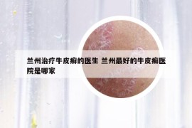 蘭州治療牛皮癬的醫(yī)生 蘭州最好的牛皮癬醫(yī)院是哪家