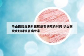 華山醫(yī)院皮膚科銀屑病專病預(yù)約時(shí)間 華山醫(yī)院皮膚科銀屑病專家