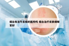 煙臺(tái)有治牛皮癬的醫(yī)院?jiǎn)?煙臺(tái)治療皮膚病哪家好