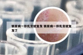 銀屑病一停乳膏就復(fù)發(fā) 銀屑病一停乳膏就復(fù)發(fā)了