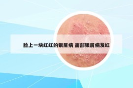 臉上一塊紅紅的銀屑病 面部銀屑病發(fā)紅