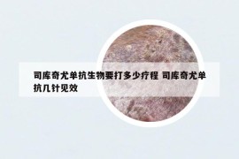 司庫(kù)奇尤單抗生物要打多少療程 司庫(kù)奇尤單抗幾針見(jiàn)效