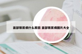 面部銀屑病什么原因 面部銀屑病圖片大全