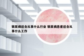 銀屑病適合從事什么行業(yè) 銀屑病患者適合從事什么工作