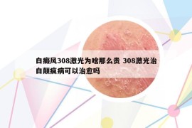 白癜風308激光為啥那么貴 308激光治白顛瘋病可以治愈嗎