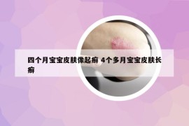 四個月寶寶皮膚像起癬 4個多月寶寶皮膚長癬