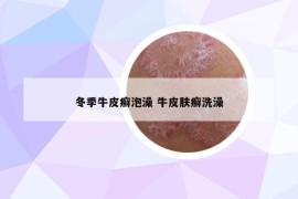 冬季牛皮癬泡澡 牛皮膚癬洗澡