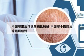中國哪里治療銀屑病比較好 中國哪個醫(yī)院治療銀屑病好