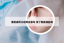 銀屑病可以吃喝涼茶嗎 得了銀屑病能喝