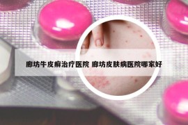 廊坊牛皮癬治療醫(yī)院 廊坊皮膚病醫(yī)院哪家好