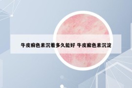 牛皮癬色素沉著多久能好 牛皮廨色素沉淀