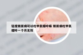 輕度銀屑病可以吃甲氨蝶呤嘛 銀屑病吃甲氨蝶呤一個月無效
