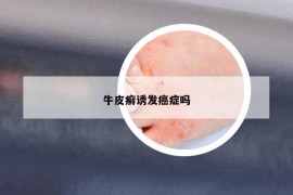 牛皮癬誘發(fā)癌癥嗎