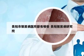 貴陽市銀屑病醫(yī)院都有哪些 貴陽銀屑病研究院