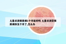 兒童點(diǎn)滴銀屑病1個月能好嗎 兒童點(diǎn)滴型銀屑病快五個月了,怎么辦