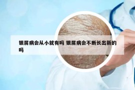 銀屑病會從小就有嗎 銀屑病會不斷長出新的嗎