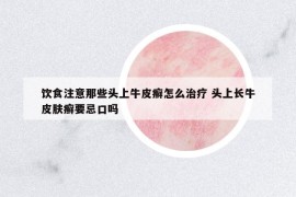 飲食注意那些頭上牛皮癬怎么治療 頭上長(zhǎng)牛皮膚癬要忌口嗎