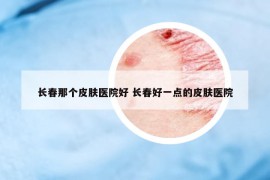 長(zhǎng)春那個(gè)皮膚醫(yī)院好 長(zhǎng)春好一點(diǎn)的皮膚醫(yī)院