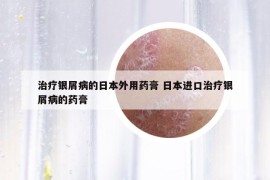 治療銀屑病的日本外用藥膏 日本進(jìn)口治療銀屑病的藥膏