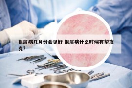 銀屑病幾月份會(huì)見好 銀屑病什么時(shí)候有望攻克?