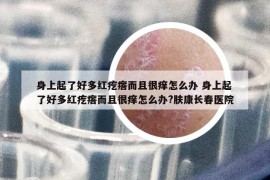 身上起了好多紅疙瘩而且很癢怎么辦 身上起了好多紅疙瘩而且很癢怎么辦?膚康長春醫(yī)院