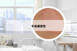 牛皮癬茶飲