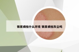 銀屑病怕什么環(huán)境 銀屑病怕灰塵嗎