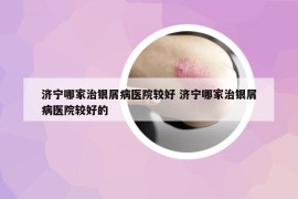 濟(jì)寧哪家治銀屑病醫(yī)院較好 濟(jì)寧哪家治銀屑病醫(yī)院較好的