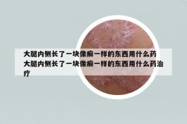 大腿內(nèi)側(cè)長了一塊像癬一樣的東西用什么藥 大腿內(nèi)側(cè)長了一塊像癬一樣的東西用什么藥治療