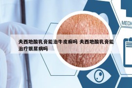 夫西地酸乳膏能治牛皮癬嗎 夫西地酸乳膏能治療銀屑病嗎