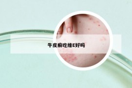 牛皮癬吃維E好嗎