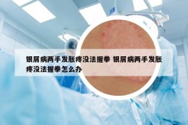 銀屑病兩手發(fā)脹疼沒法握拳 銀屑病兩手發(fā)脹疼沒法握拳怎么辦
