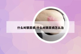 什么叫銀屑病 什么叫銀屑病怎么治