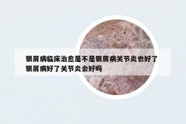 銀屑病臨床治愈是不是銀屑病關(guān)節(jié)炎也好了 銀屑病好了關(guān)節(jié)炎會好嗎