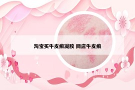 淘寶買牛皮癬凝膠 網(wǎng)店牛皮癬