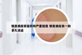 銀屑病皮損面積和嚴(yán)重程度 銀屑病皮損一般多久消退