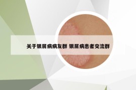 關(guān)于銀屑病病友群 銀屑病患者交流群