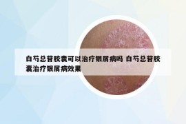 白芍總苷膠囊可以治療銀屑病嗎 白芍總苷膠囊治療銀屑病效果