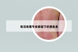 有沒(méi)有看牛皮癬留下的黑色素