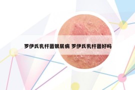 羅伊氏乳桿菌銀屑病 羅伊氏乳桿菌好嗎